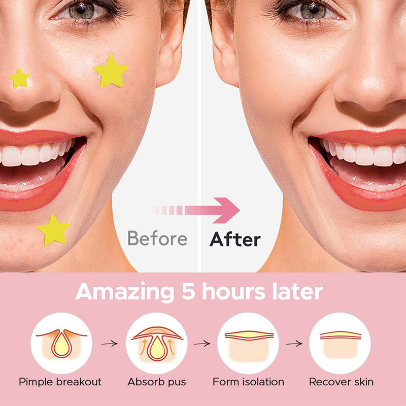 600 ชิ้น/เซ็ต Star Pimple Patc - Beauty Makeup Tool บทวิจารณ์และราคา